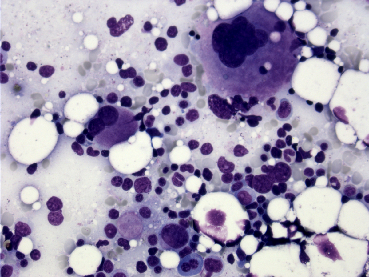 Bone marrow aspirate smear (BM-2), Wright-Giemsa stain, x400